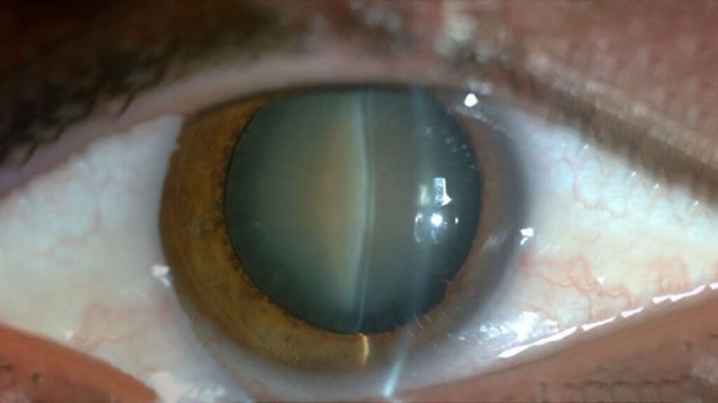 cataract surgery