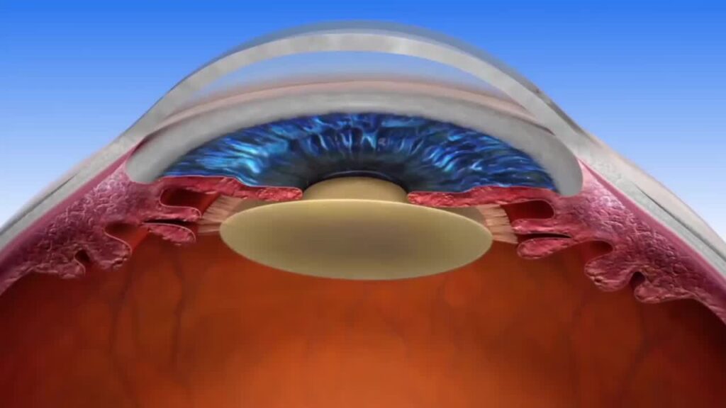 Non-Surgical Cataracts Treatment Options And Their Real-World Limits

