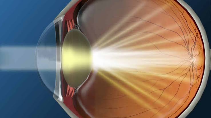 Non-Surgical Cataracts Treatment Options And Their Real-World Limits

