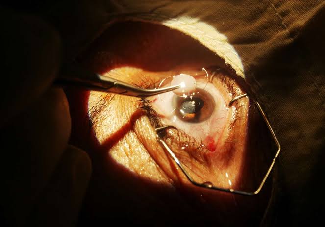 How Do You Know When It Is Time For Cataract Surgery?

