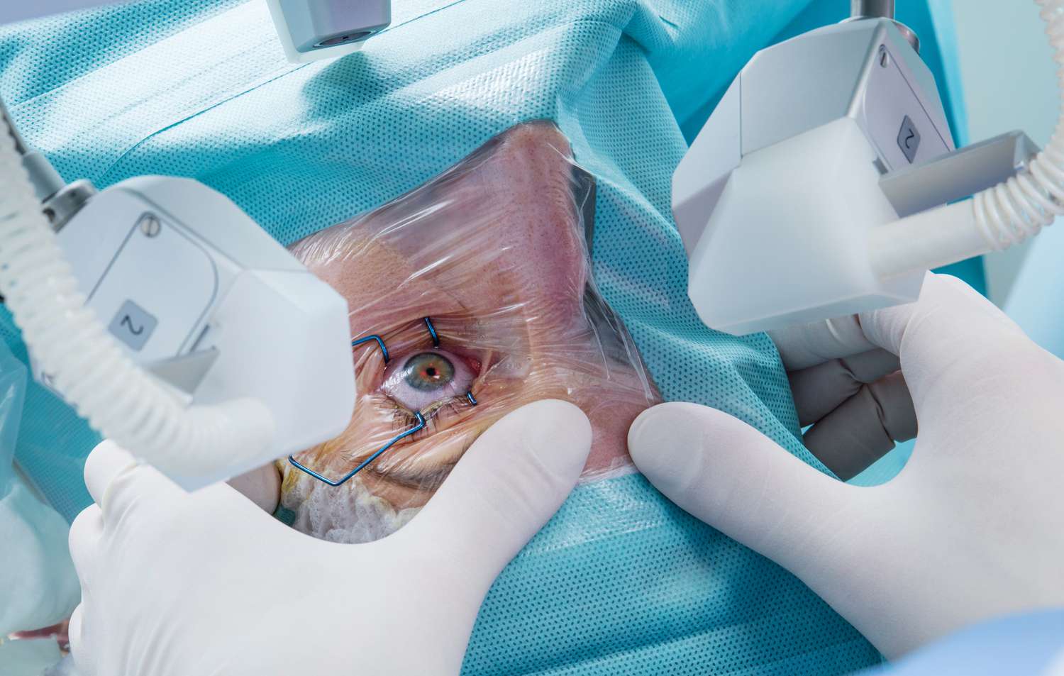What Happens Step By Step During Cataract Eye Surgery?